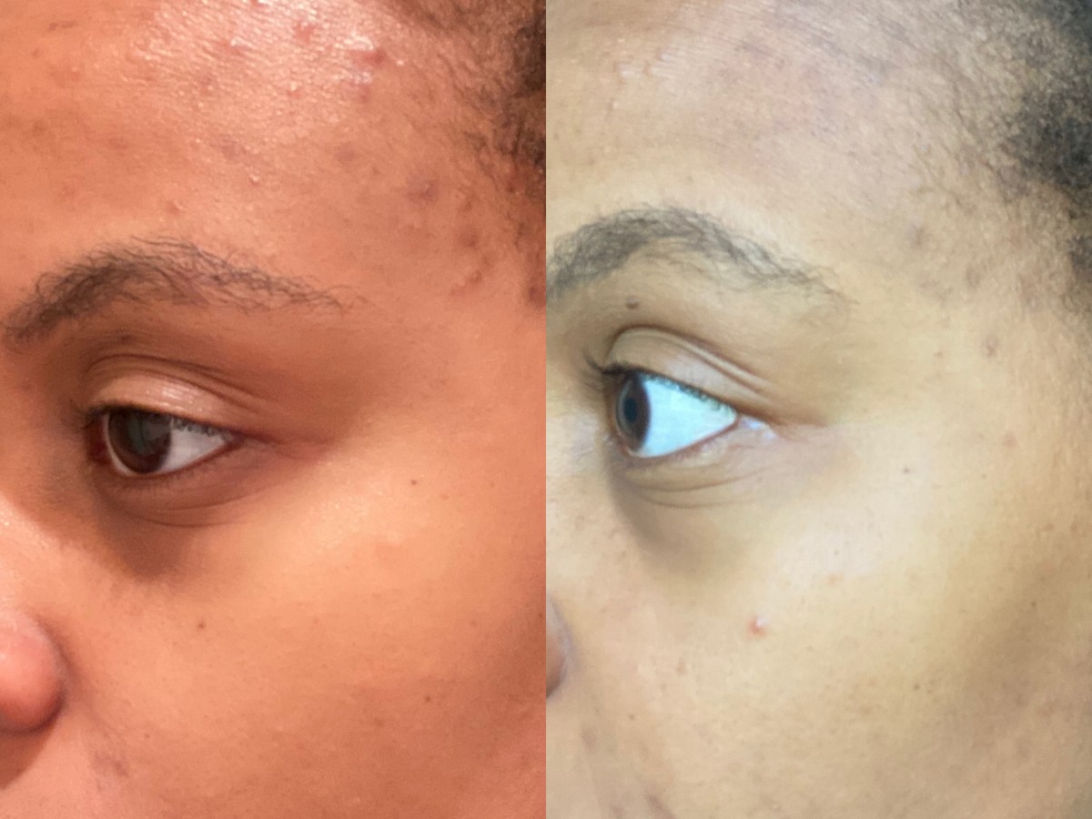 My Fall Skincare Routine for My Adult Acne